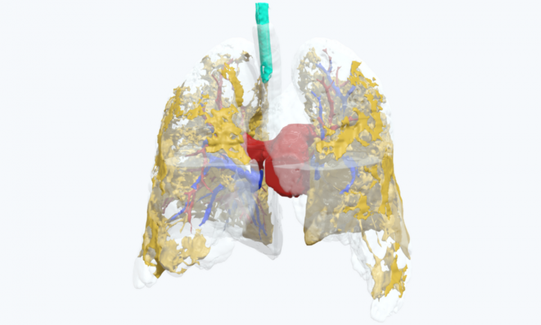 Axial3D COVID-19肺模型